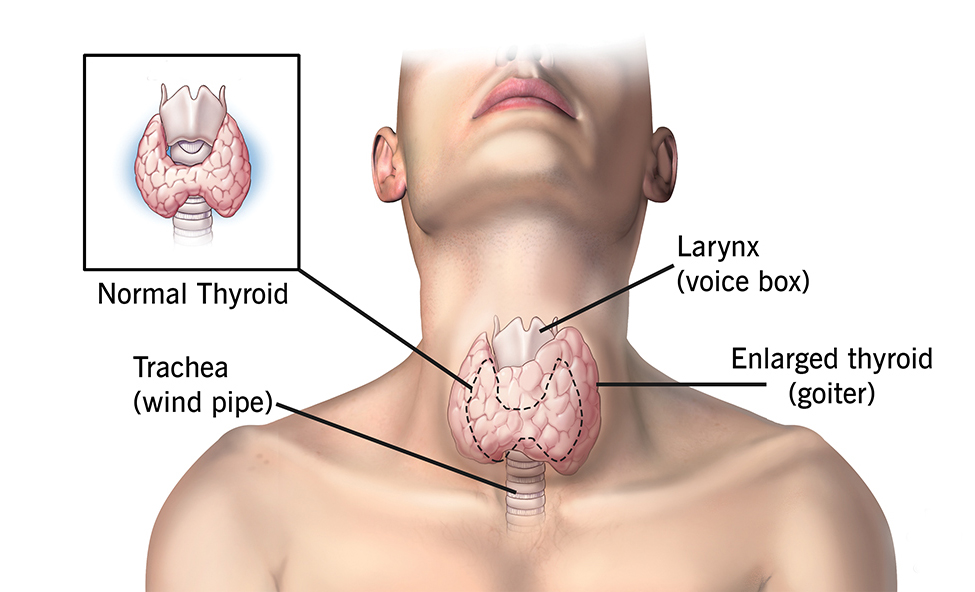 HYPOTHYROID MANAGEMENT